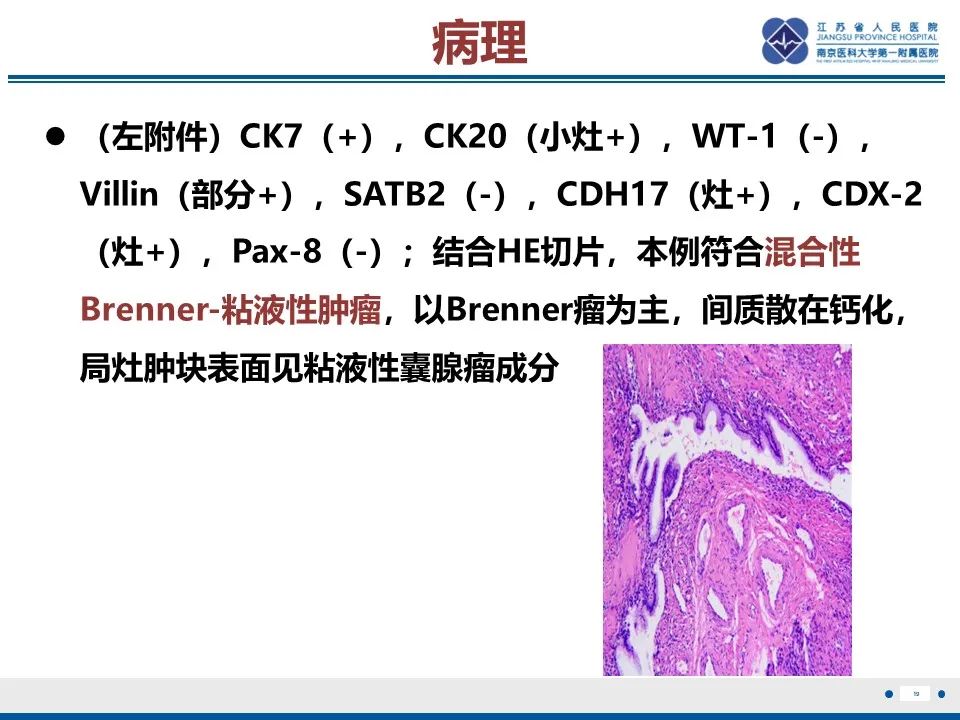 影像PPT - 【PPT】卵巢纤维上皮瘤-19