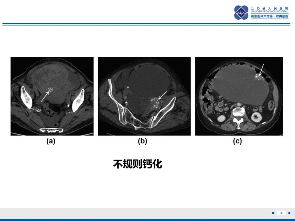 影像PPT - 【PPT】卵巢纤维上皮瘤-28