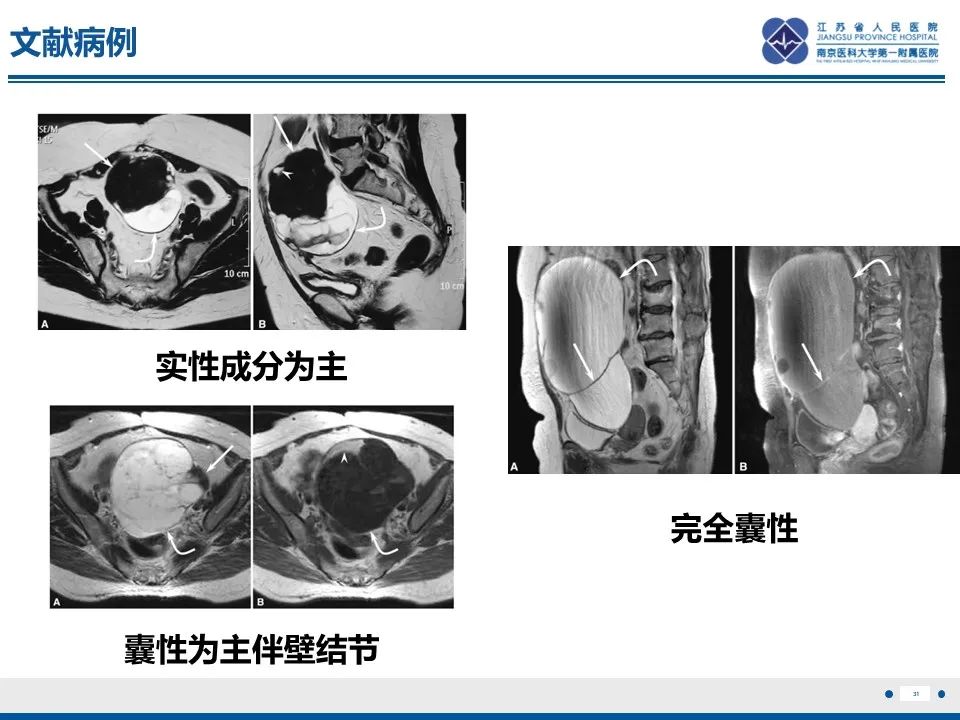 影像PPT - 【PPT】卵巢纤维上皮瘤-31