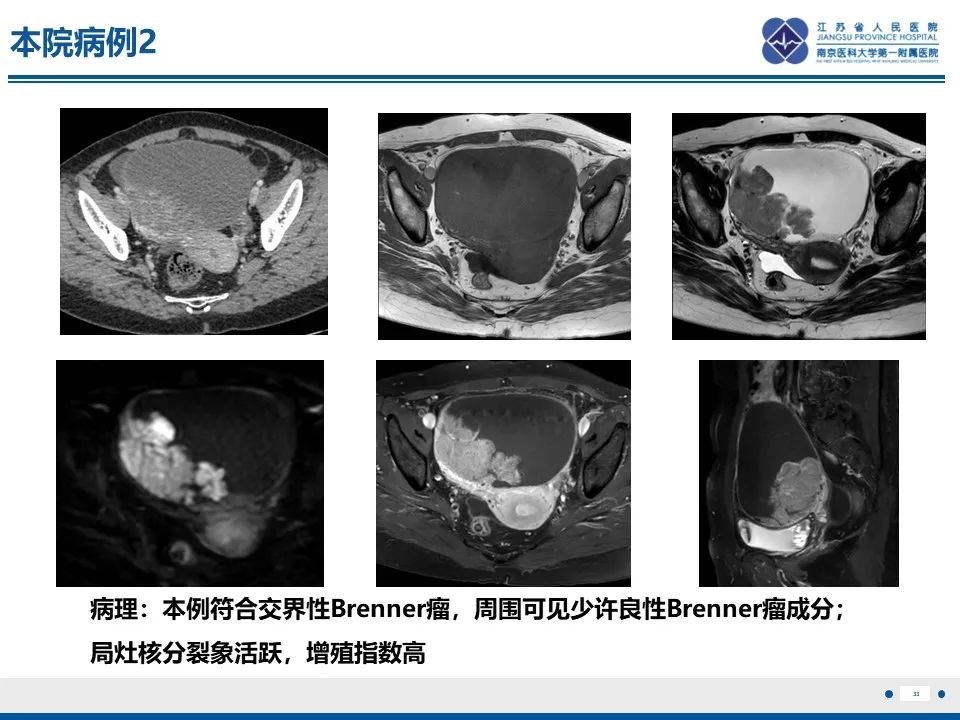 影像PPT - 【PPT】卵巢纤维上皮瘤-33