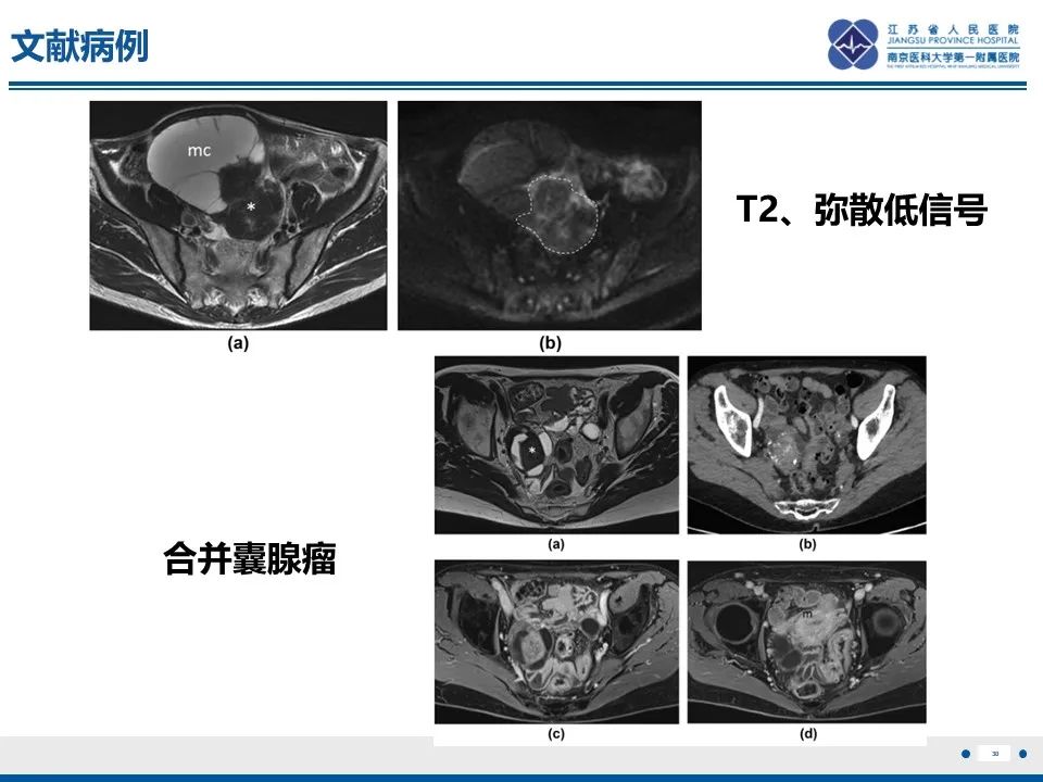 影像PPT - 【PPT】卵巢纤维上皮瘤-30