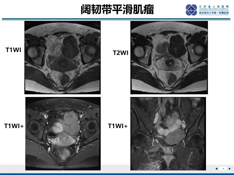 影像PPT - 【PPT】卵巢纤维上皮瘤-36
