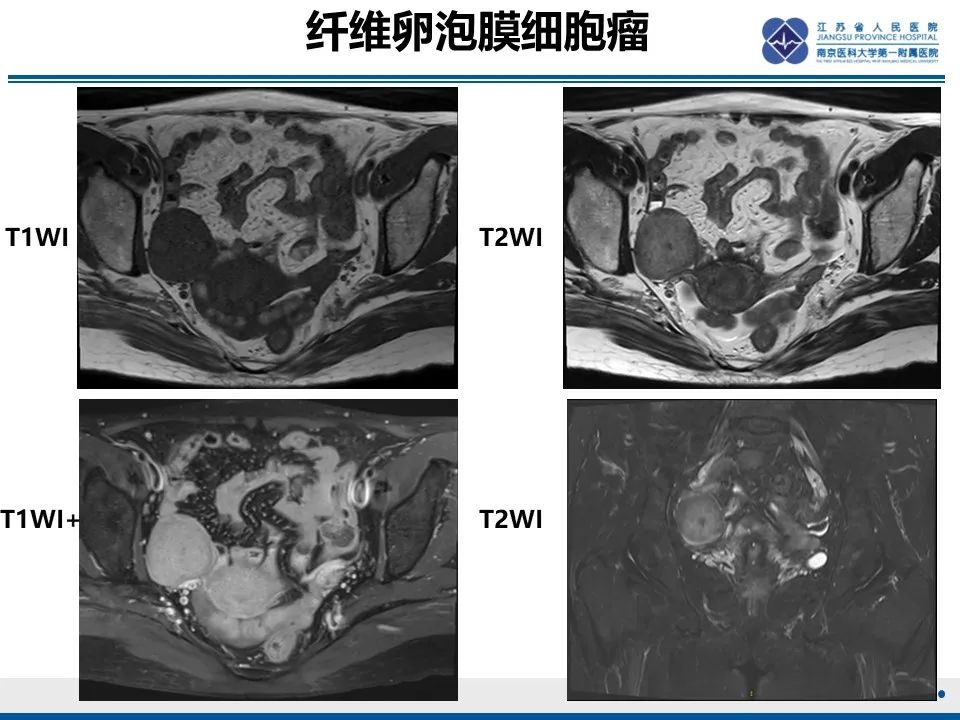 影像PPT - 【PPT】卵巢纤维上皮瘤-38