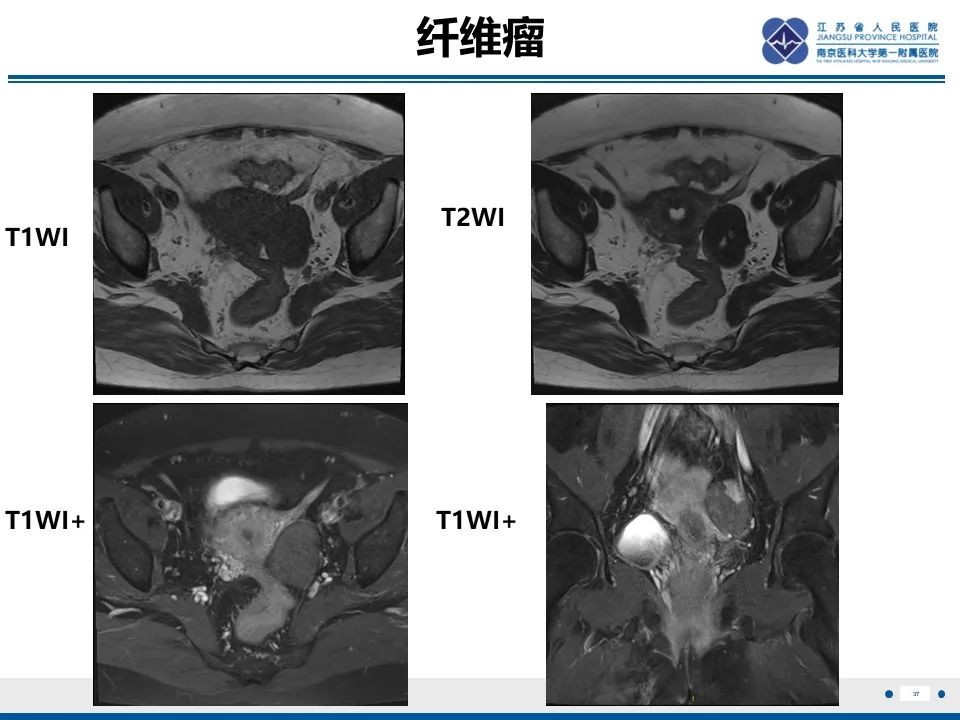 影像PPT - 【PPT】卵巢纤维上皮瘤-37