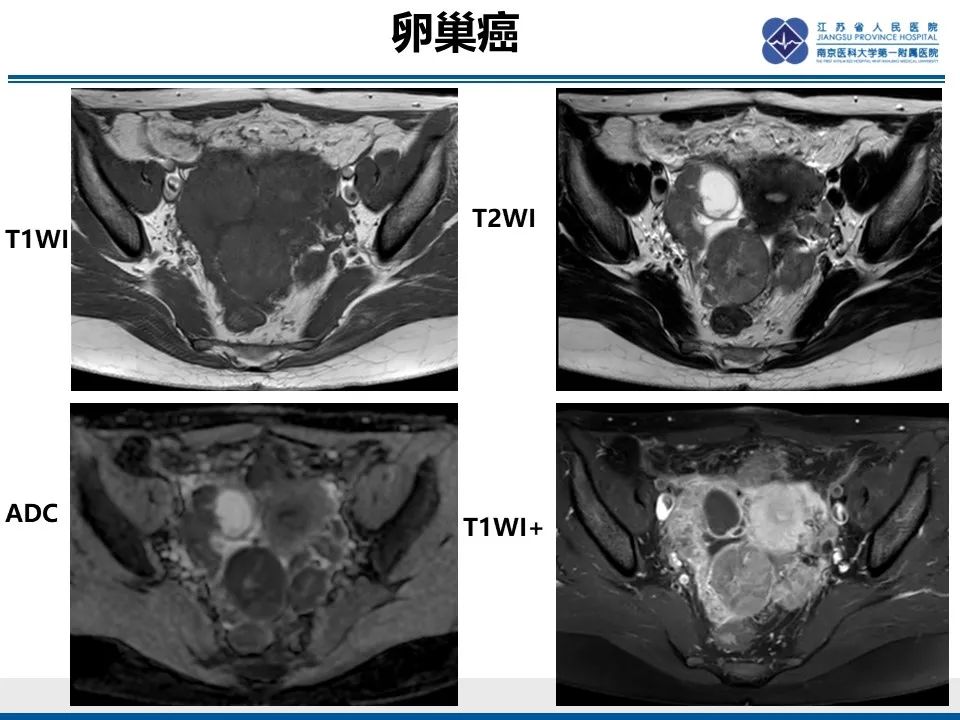 影像PPT - 【PPT】卵巢纤维上皮瘤-40
