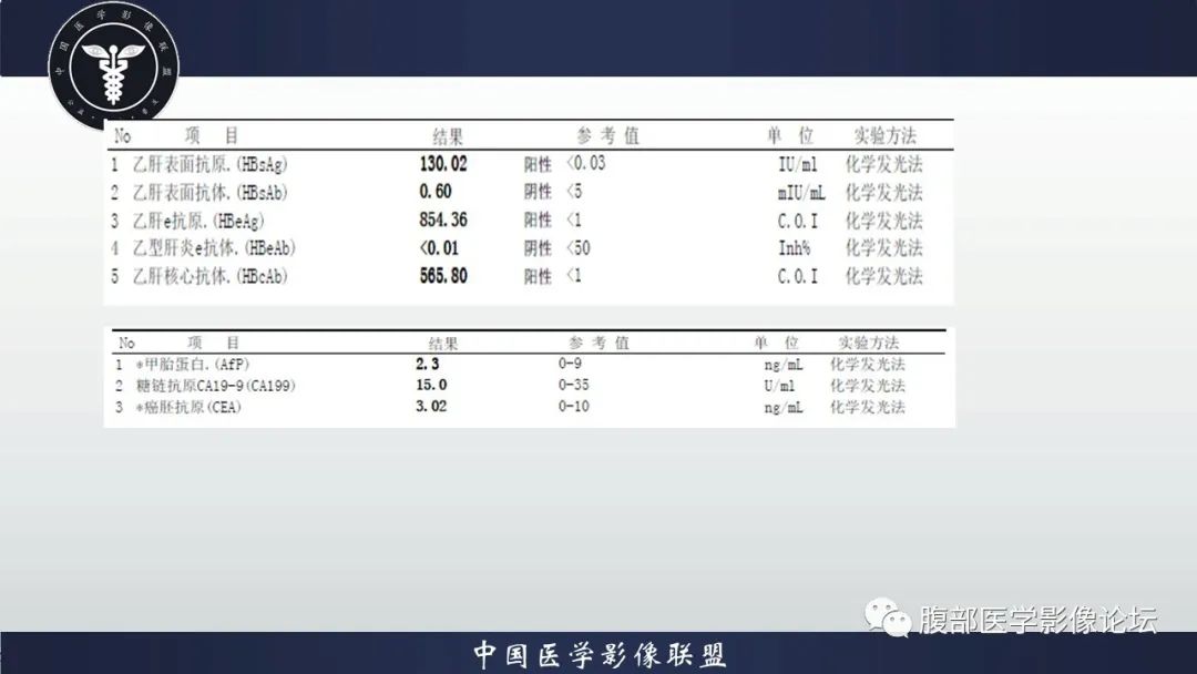影像PPT - 【病例】原发性肝脏淋巴瘤1例CT及MR-6 影像PPT - 【病例】原发性肝脏淋巴瘤1例CT及MR-6