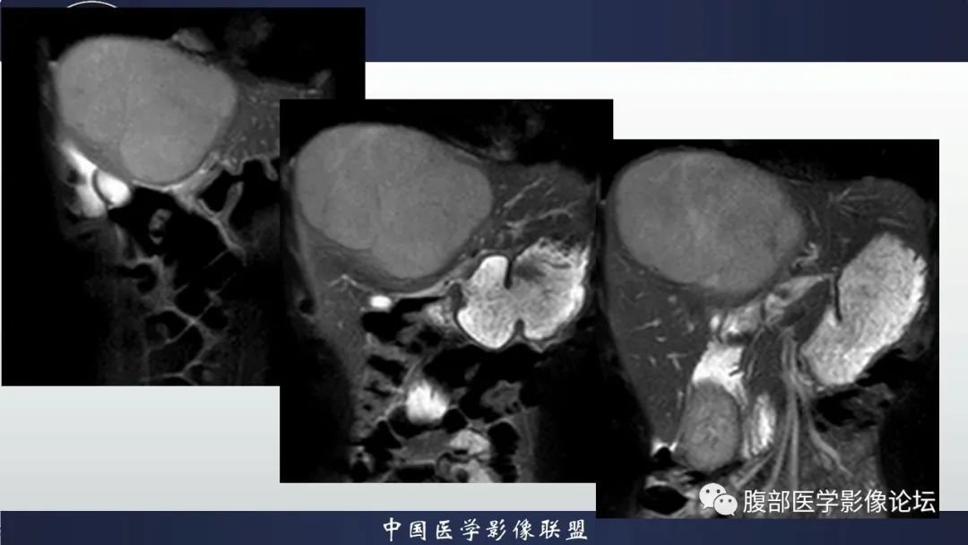 影像PPT - 【病例】原发性肝脏淋巴瘤1例CT及MR-8 影像PPT - 【病例】原发性肝脏淋巴瘤1例CT及MR-8