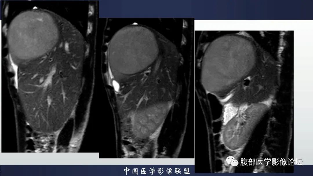影像PPT - 【病例】原发性肝脏淋巴瘤1例CT及MR-9 影像PPT - 【病例】原发性肝脏淋巴瘤1例CT及MR-9