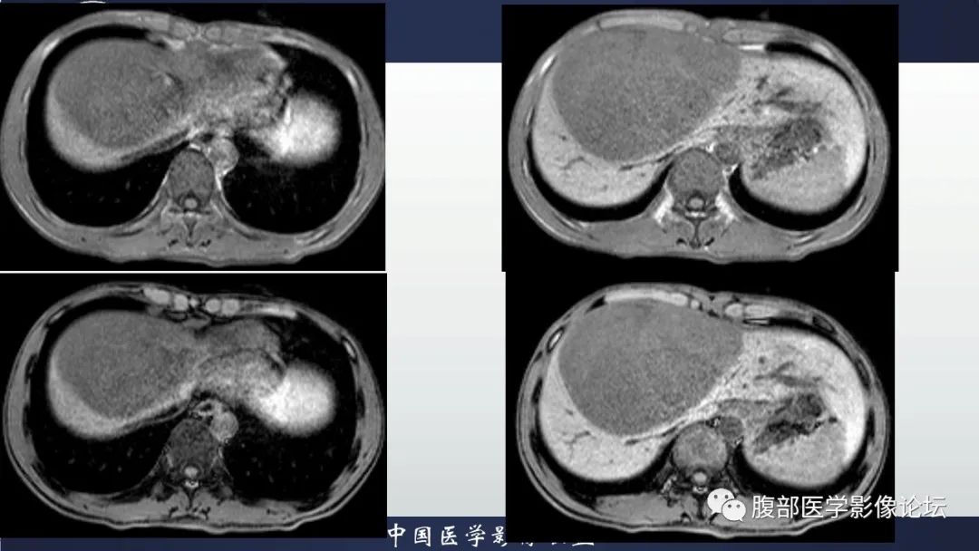 影像PPT - 【病例】原发性肝脏淋巴瘤1例CT及MR-12 影像PPT - 【病例】原发性肝脏淋巴瘤1例CT及MR-12