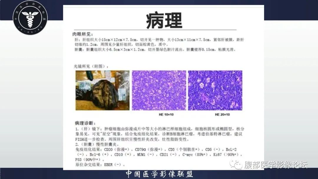 影像PPT - 【病例】原发性肝脏淋巴瘤1例CT及MR-19 影像PPT - 【病例】原发性肝脏淋巴瘤1例CT及MR-19