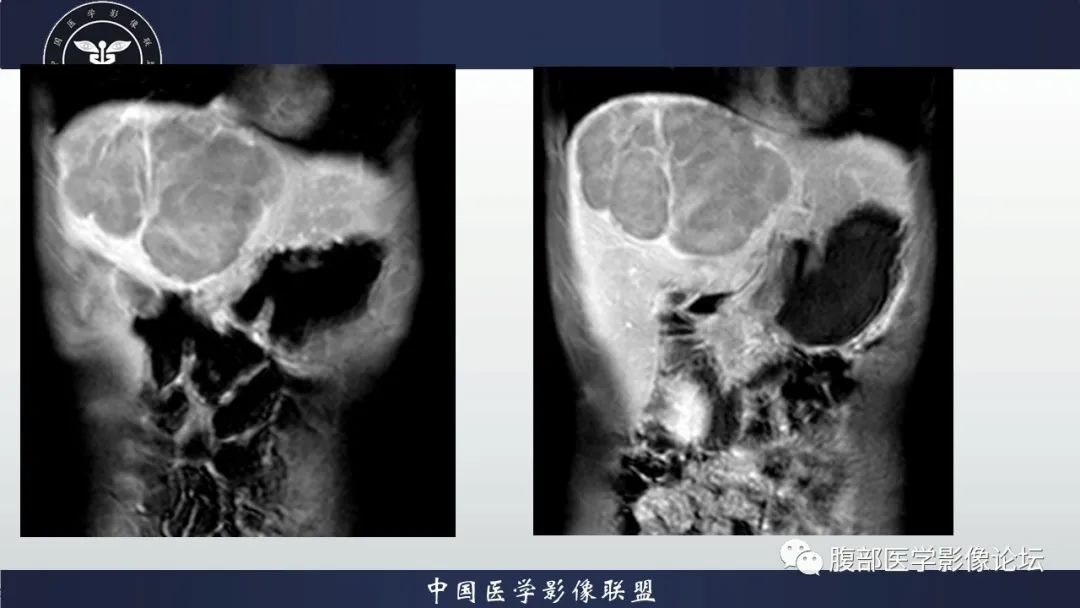影像PPT - 【病例】原发性肝脏淋巴瘤1例CT及MR-17 影像PPT - 【病例】原发性肝脏淋巴瘤1例CT及MR-17
