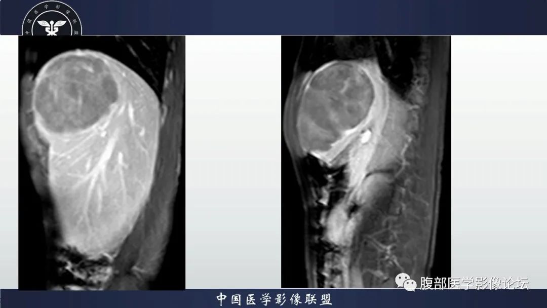 影像PPT - 【病例】原发性肝脏淋巴瘤1例CT及MR-18 影像PPT - 【病例】原发性肝脏淋巴瘤1例CT及MR-18