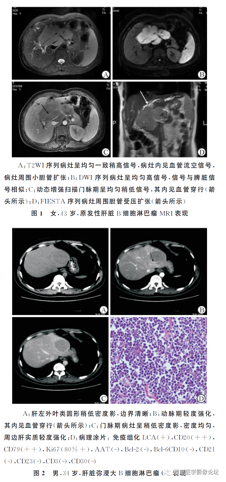 影像PPT - 【病例】原发性肝脏淋巴瘤1例CT及MR-20 影像PPT - 【病例】原发性肝脏淋巴瘤1例CT及MR-20