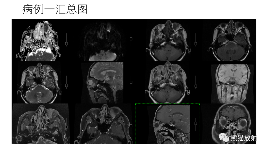 影像PPT - 【病例】眼眶肌锥外间隙 淋巴瘤 VS 孤立性纤维瘤-12