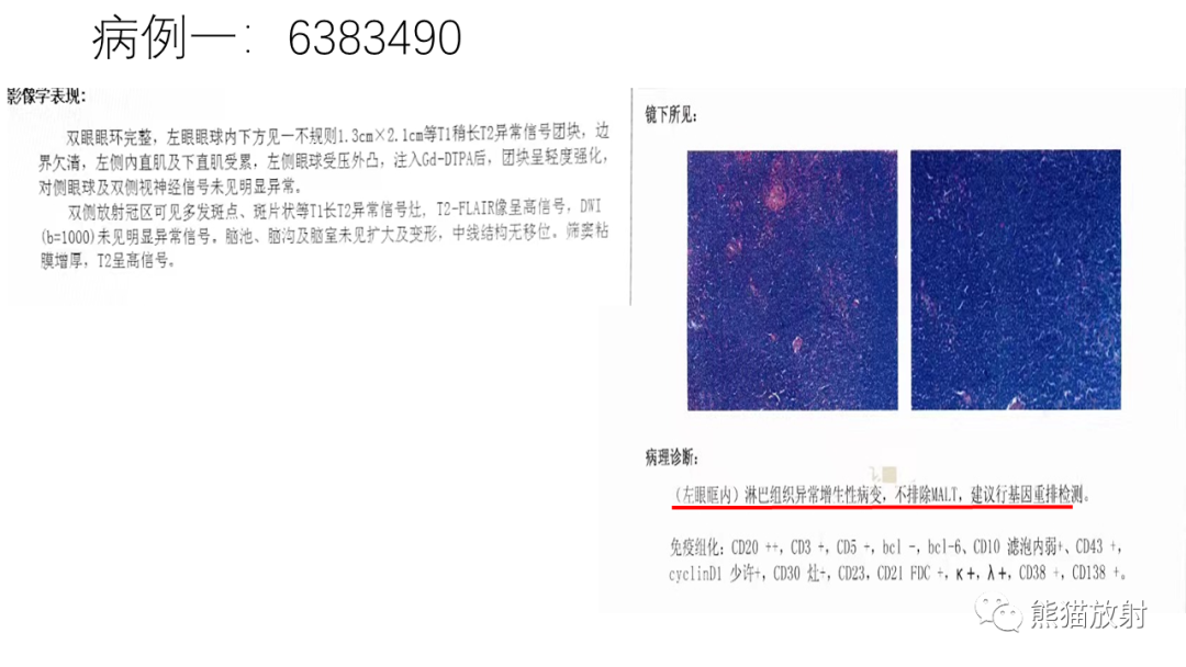 影像PPT - 【病例】眼眶肌锥外间隙 淋巴瘤 VS 孤立性纤维瘤-22