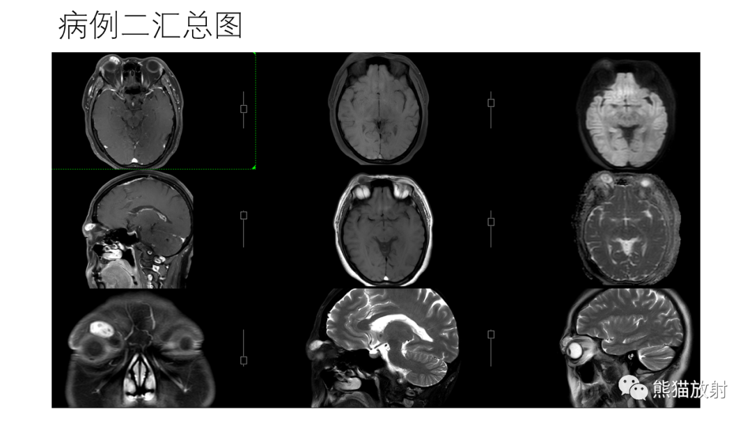 影像PPT - 【病例】眼眶肌锥外间隙 淋巴瘤 VS 孤立性纤维瘤-20