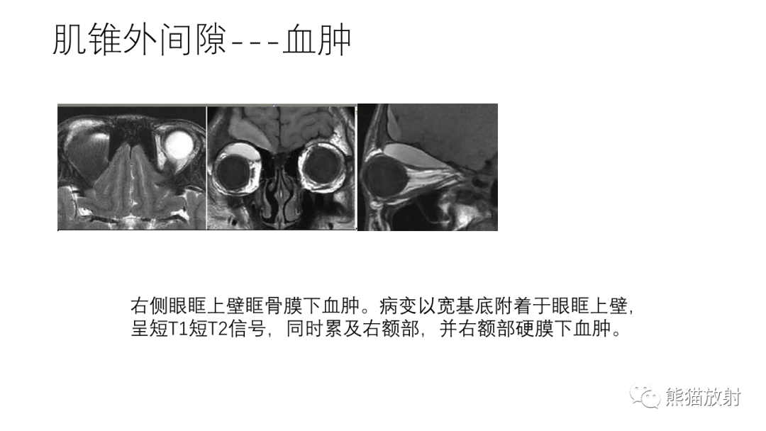 影像PPT - 【病例】眼眶肌锥外间隙 淋巴瘤 VS 孤立性纤维瘤-27