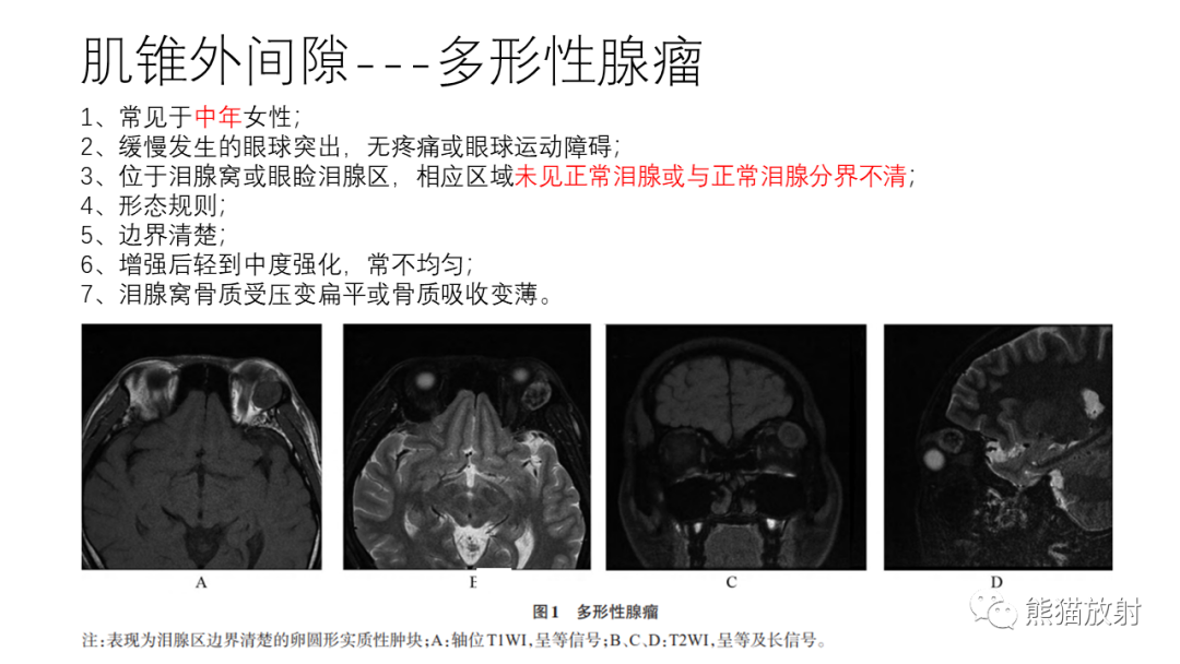 影像PPT - 【病例】眼眶肌锥外间隙 淋巴瘤 VS 孤立性纤维瘤-28