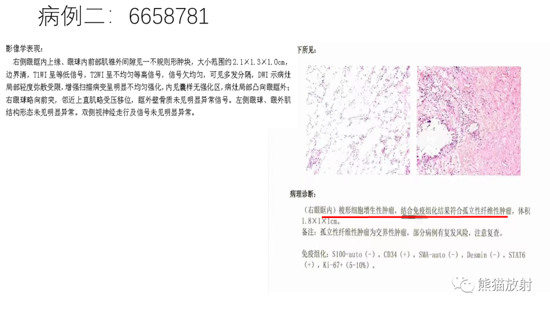 影像PPT - 【病例】眼眶肌锥外间隙 淋巴瘤 VS 孤立性纤维瘤-24