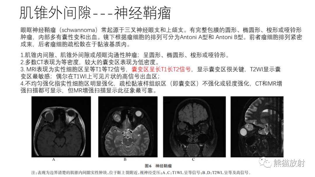 影像PPT - 【病例】眼眶肌锥外间隙 淋巴瘤 VS 孤立性纤维瘤-29