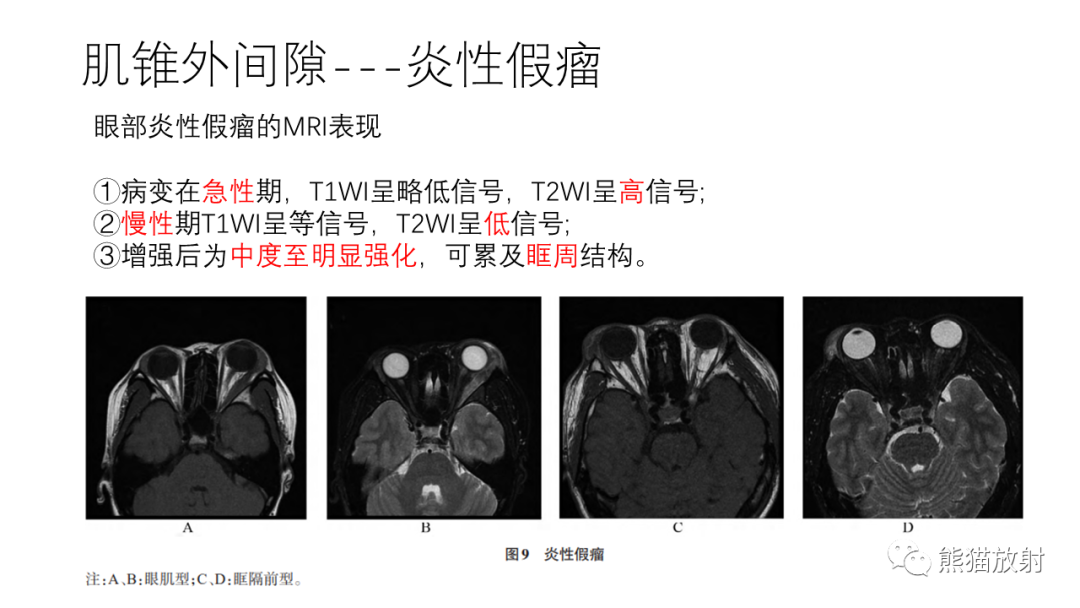 影像PPT - 【病例】眼眶肌锥外间隙 淋巴瘤 VS 孤立性纤维瘤-33