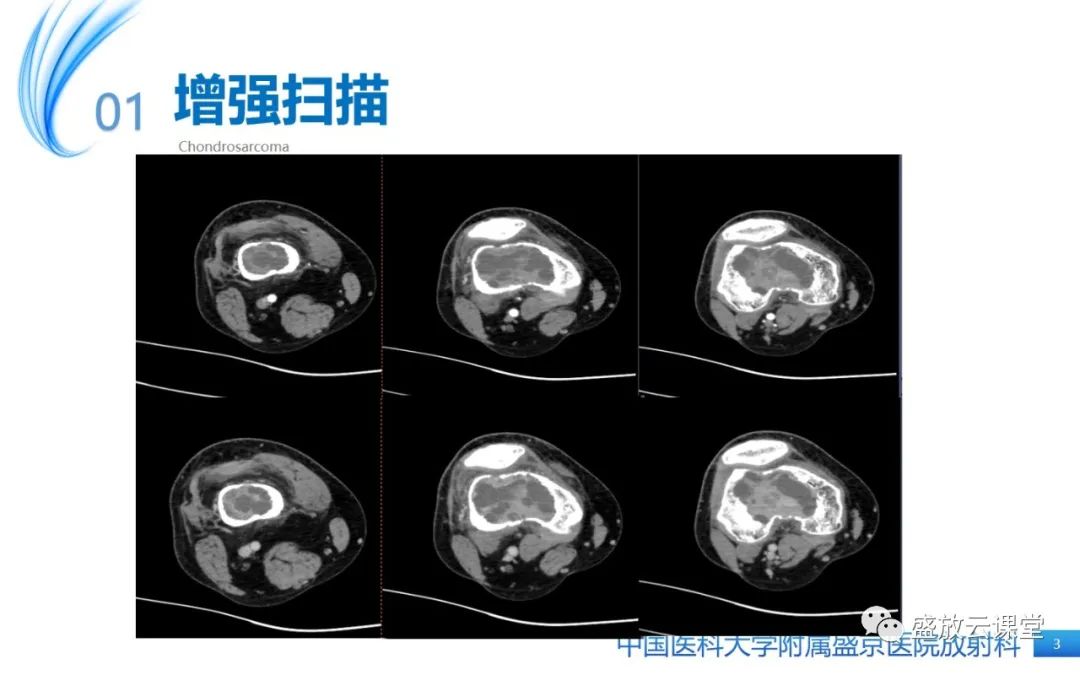 影像PPT - 【病例】长骨骨巨细胞瘤 VS 脊柱骨巨细胞瘤-3
