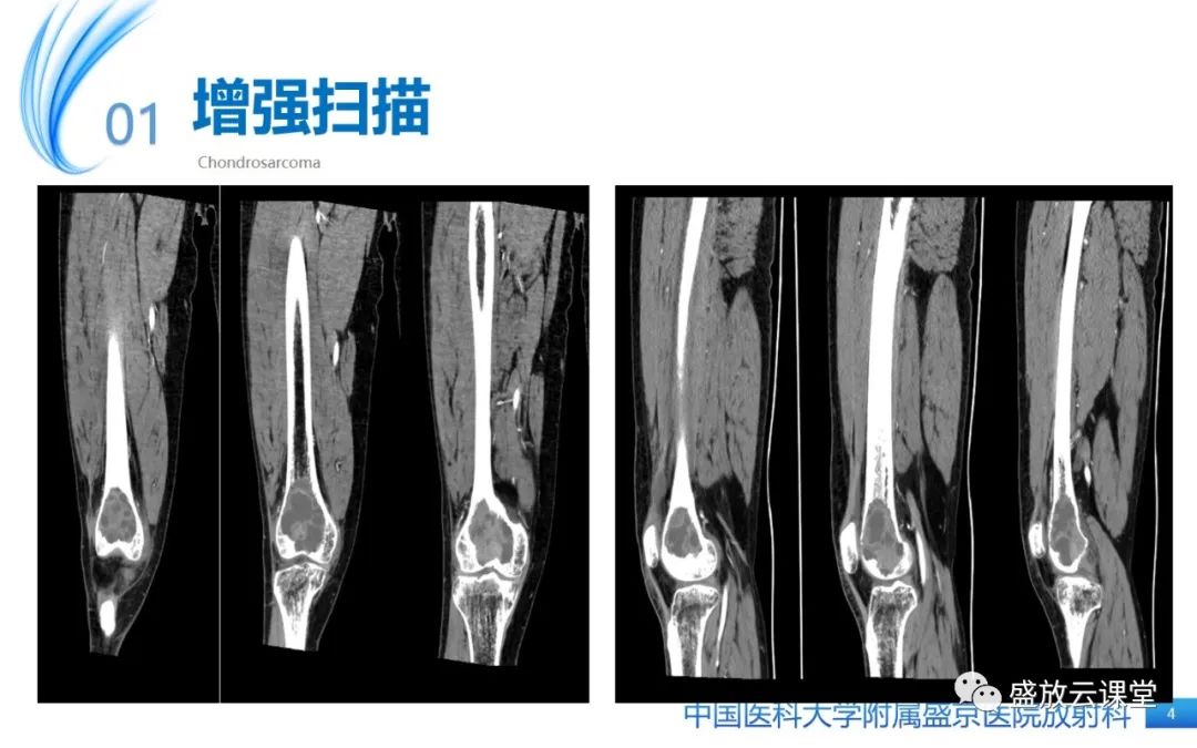 影像PPT - 【病例】长骨骨巨细胞瘤 VS 脊柱骨巨细胞瘤-4