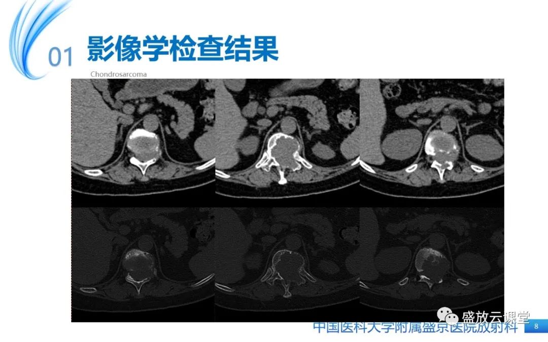 影像PPT - 【病例】长骨骨巨细胞瘤 VS 脊柱骨巨细胞瘤-8