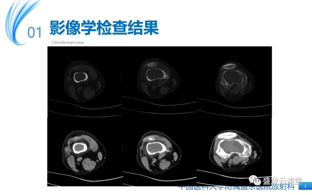 影像PPT - 【病例】长骨骨巨细胞瘤 VS 脊柱骨巨细胞瘤-2