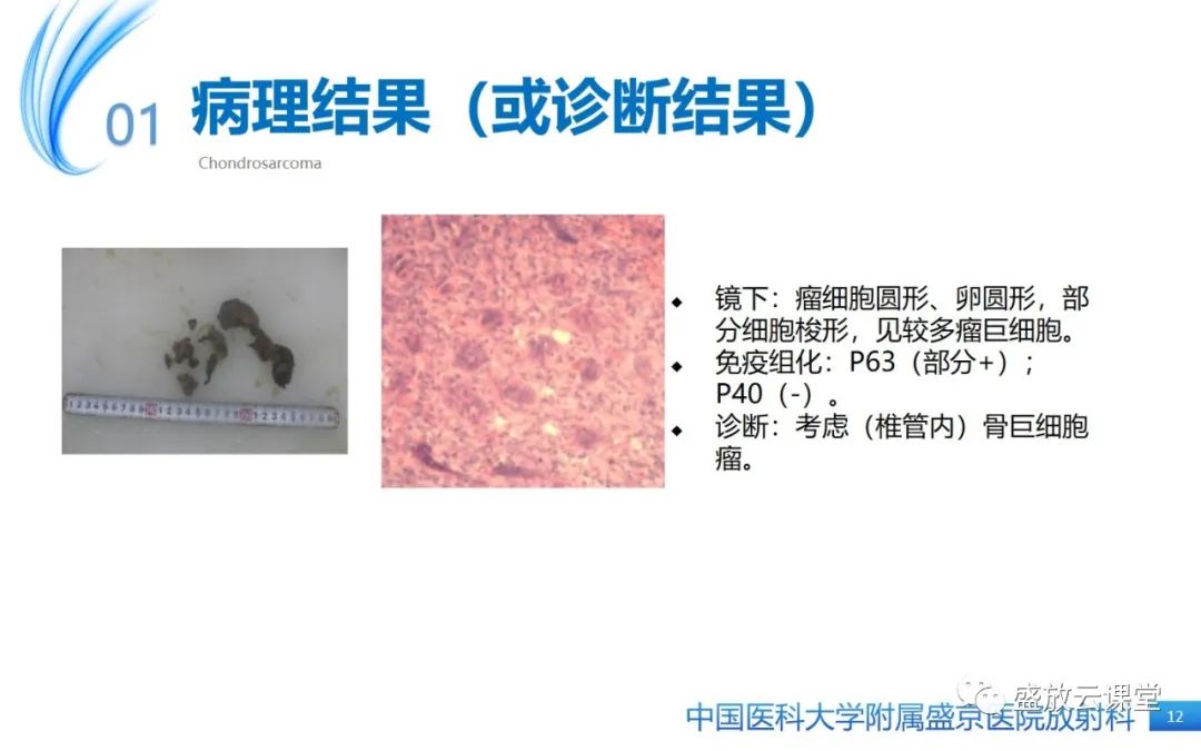 影像PPT - 【病例】长骨骨巨细胞瘤 VS 脊柱骨巨细胞瘤-11