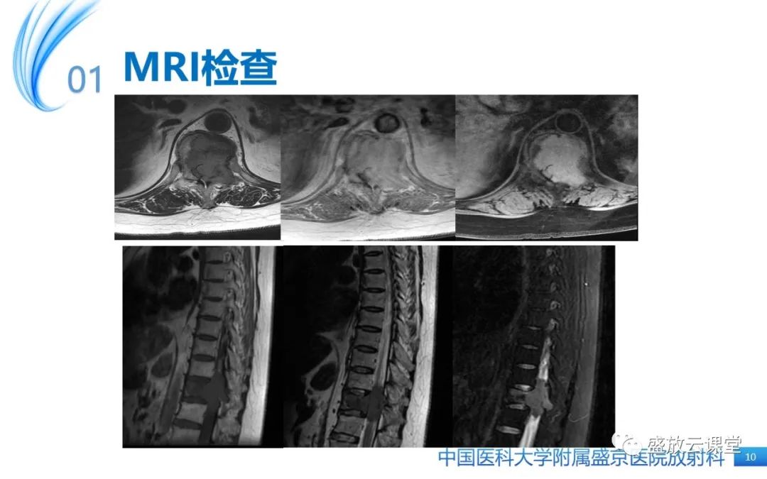 影像PPT - 【病例】长骨骨巨细胞瘤 VS 脊柱骨巨细胞瘤-10
