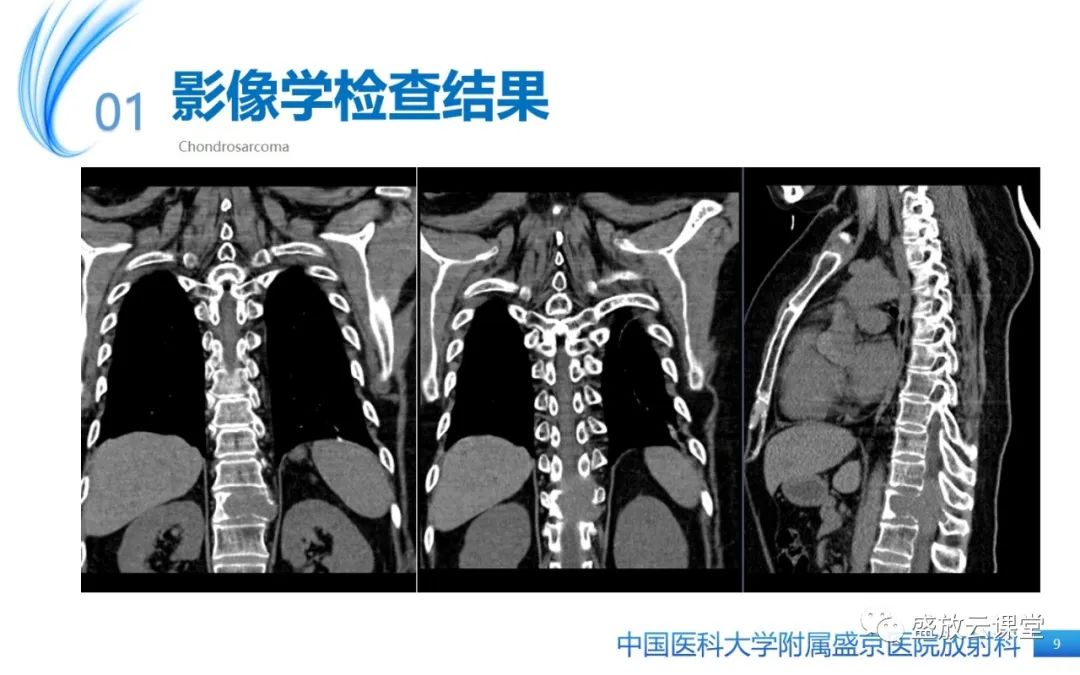 影像PPT - 【病例】长骨骨巨细胞瘤 VS 脊柱骨巨细胞瘤-9