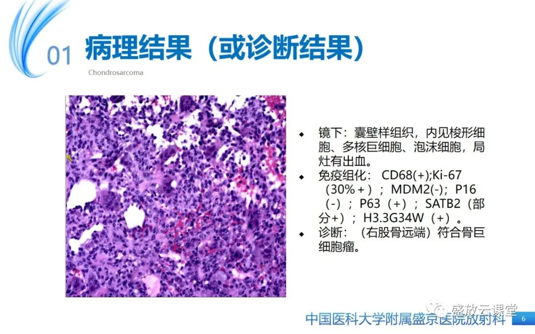 影像PPT - 【病例】长骨骨巨细胞瘤 VS 脊柱骨巨细胞瘤-6