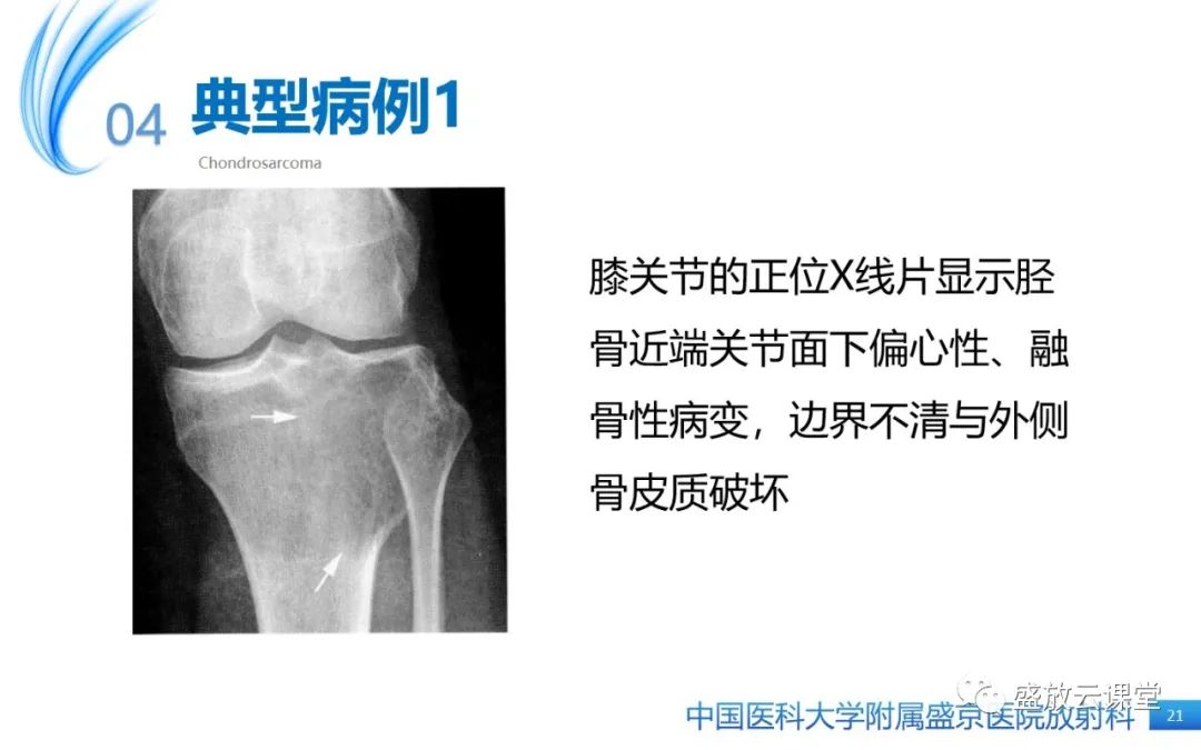 影像PPT - 【病例】长骨骨巨细胞瘤 VS 脊柱骨巨细胞瘤-20
