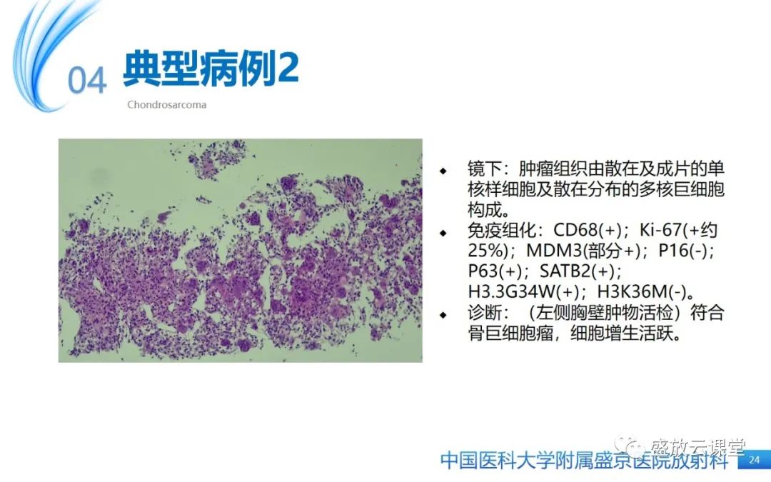 影像PPT - 【病例】长骨骨巨细胞瘤 VS 脊柱骨巨细胞瘤-23