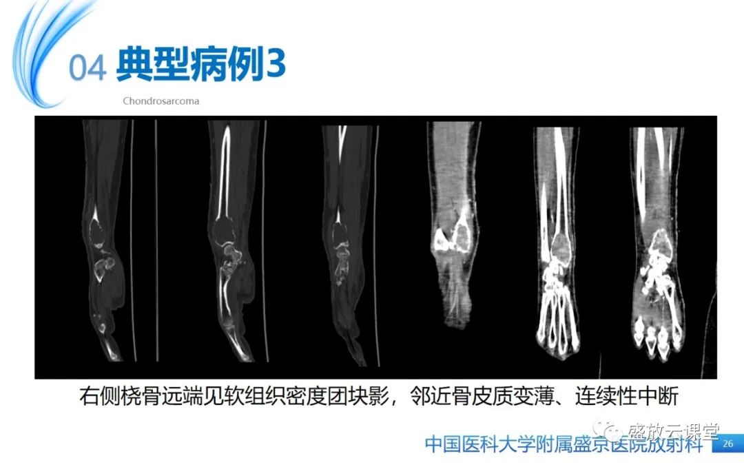 影像PPT - 【病例】长骨骨巨细胞瘤 VS 脊柱骨巨细胞瘤-25