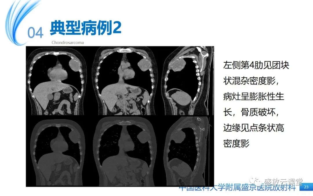 影像PPT - 【病例】长骨骨巨细胞瘤 VS 脊柱骨巨细胞瘤-22