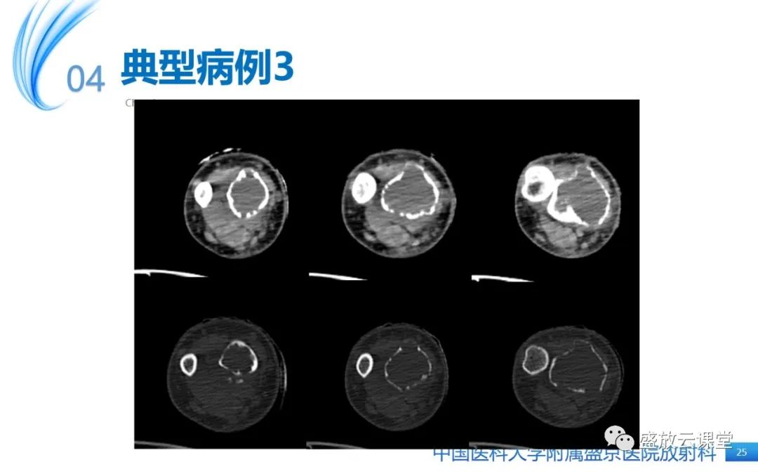 影像PPT - 【病例】长骨骨巨细胞瘤 VS 脊柱骨巨细胞瘤-24