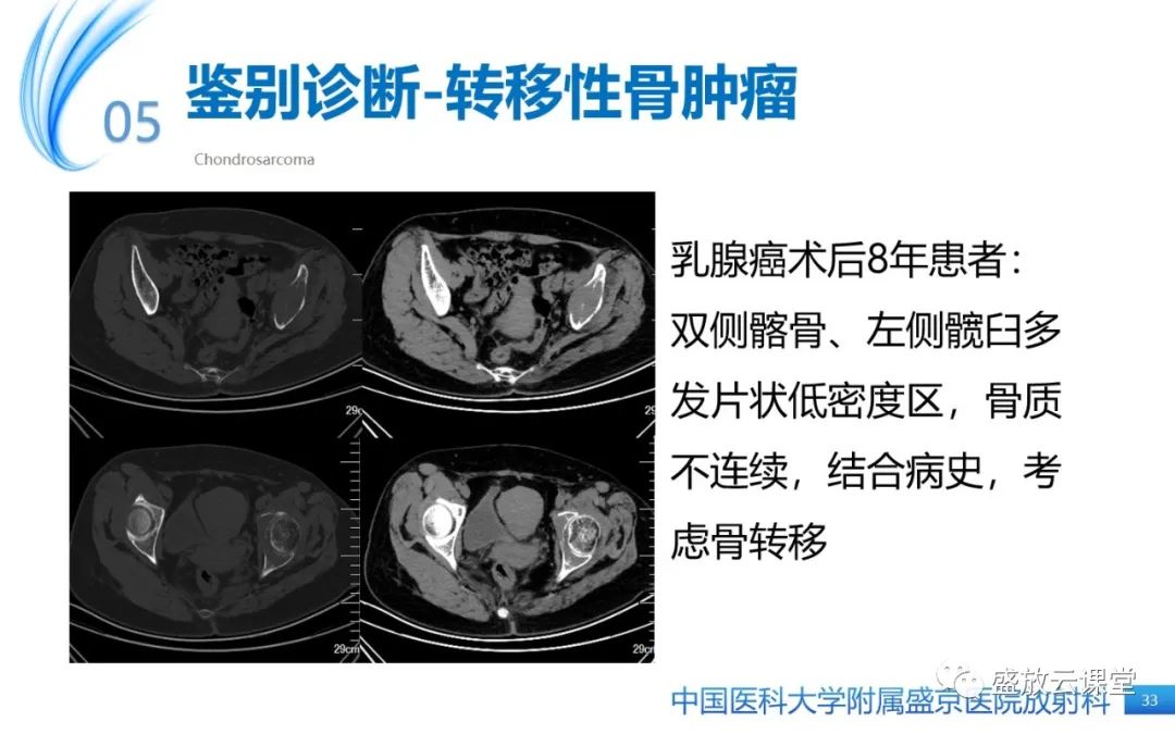 影像PPT - 【病例】长骨骨巨细胞瘤 VS 脊柱骨巨细胞瘤-32