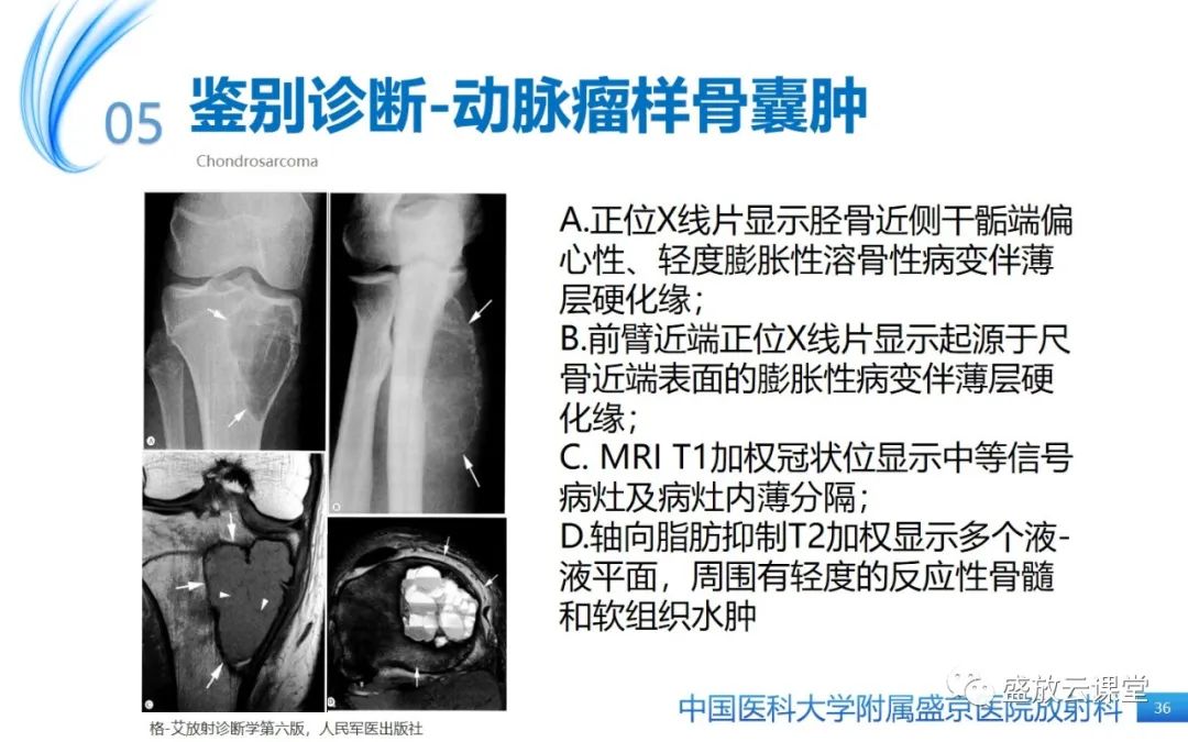 影像PPT - 【病例】长骨骨巨细胞瘤 VS 脊柱骨巨细胞瘤-35