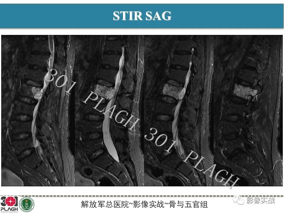 影像PPT - 【病例】腰椎脊索瘤1例MR-5