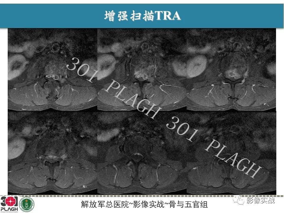 影像PPT - 【病例】腰椎脊索瘤1例MR-8