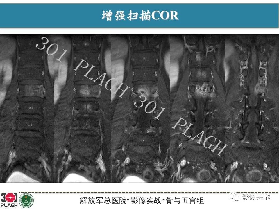 影像PPT - 【病例】腰椎脊索瘤1例MR-9
