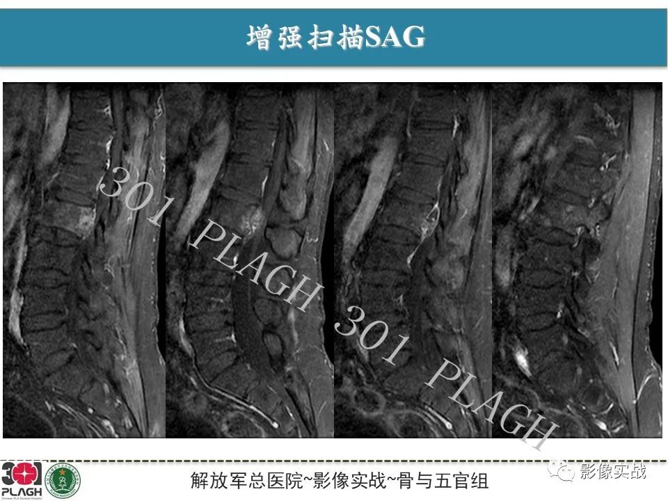 影像PPT - 【病例】腰椎脊索瘤1例MR-7