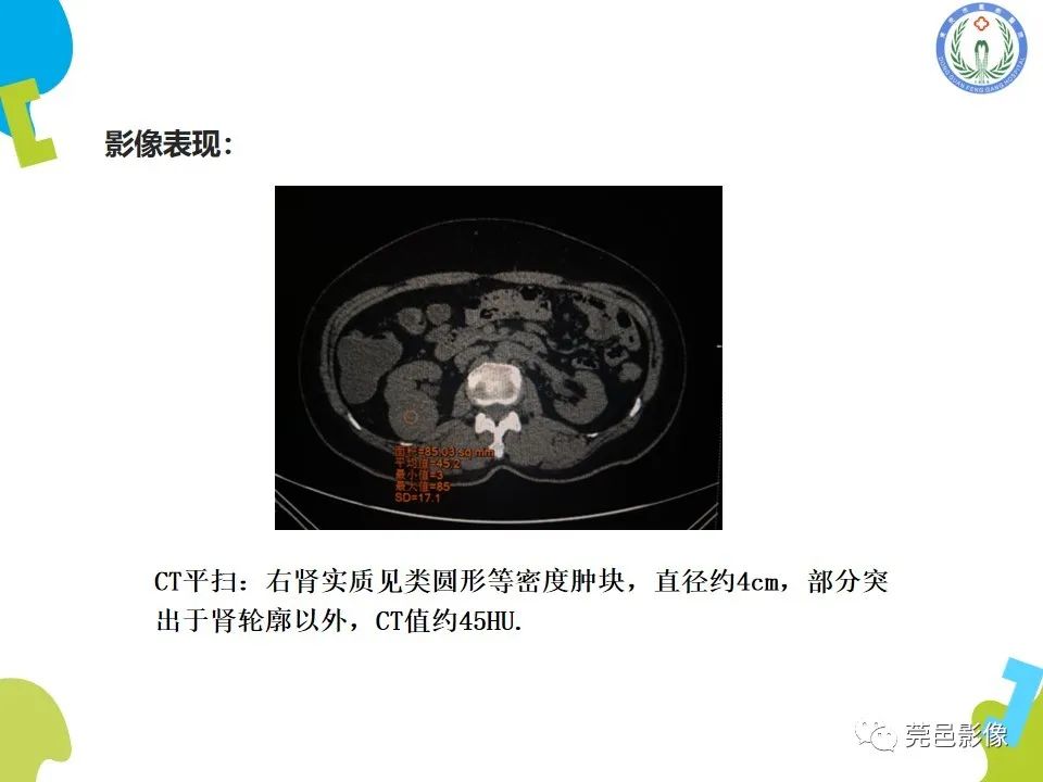 影像PPT - 【PPT】肾嫌色细胞癌影像表现及鉴别诊断-4