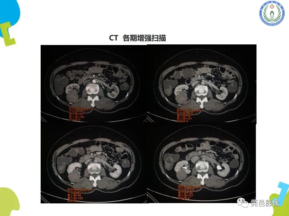 影像PPT - 【PPT】肾嫌色细胞癌影像表现及鉴别诊断-5