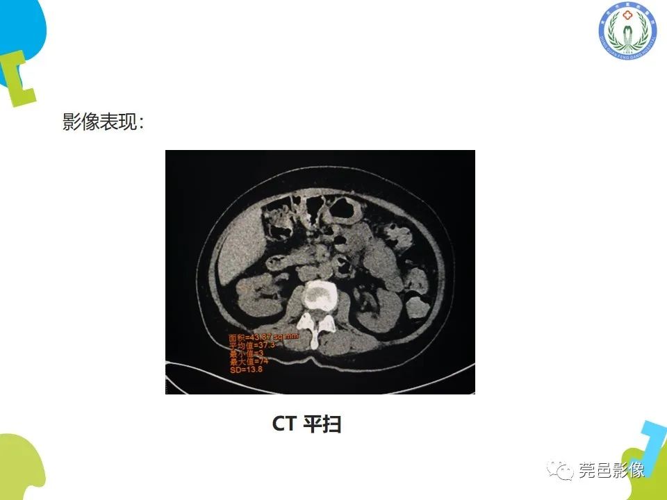 影像PPT - 【PPT】肾嫌色细胞癌影像表现及鉴别诊断-9
