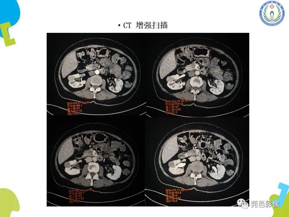 影像PPT - 【PPT】肾嫌色细胞癌影像表现及鉴别诊断-10