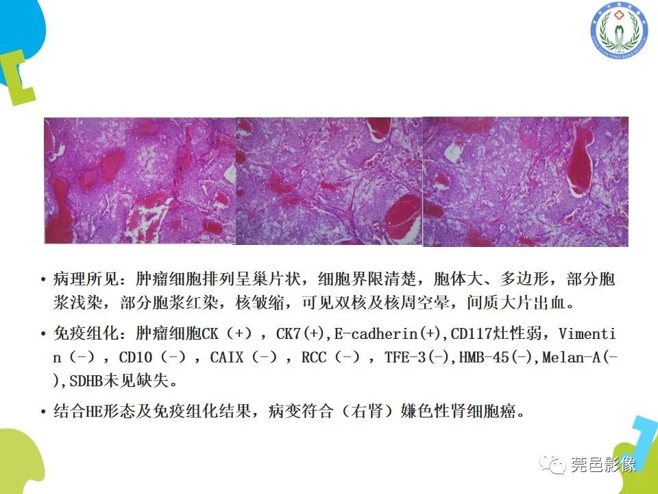 影像PPT - 【PPT】肾嫌色细胞癌影像表现及鉴别诊断-13