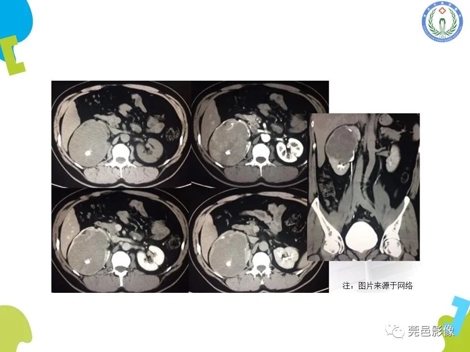 影像PPT - 【PPT】肾嫌色细胞癌影像表现及鉴别诊断-19